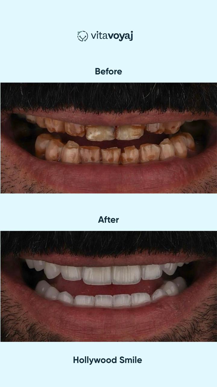 Hollywood Smile (8 Upper Teeth) - Image 16
