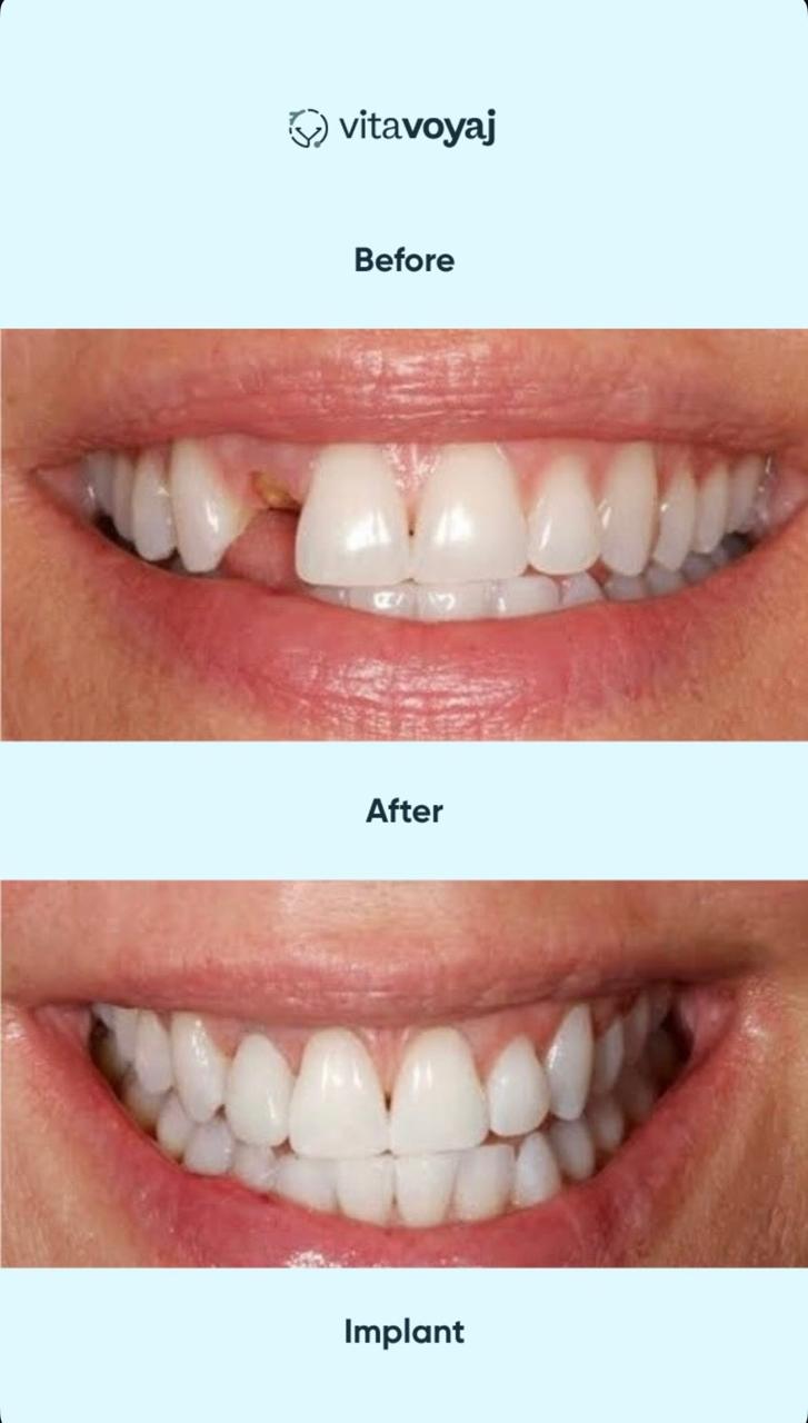 Implant with Crown - Image 2