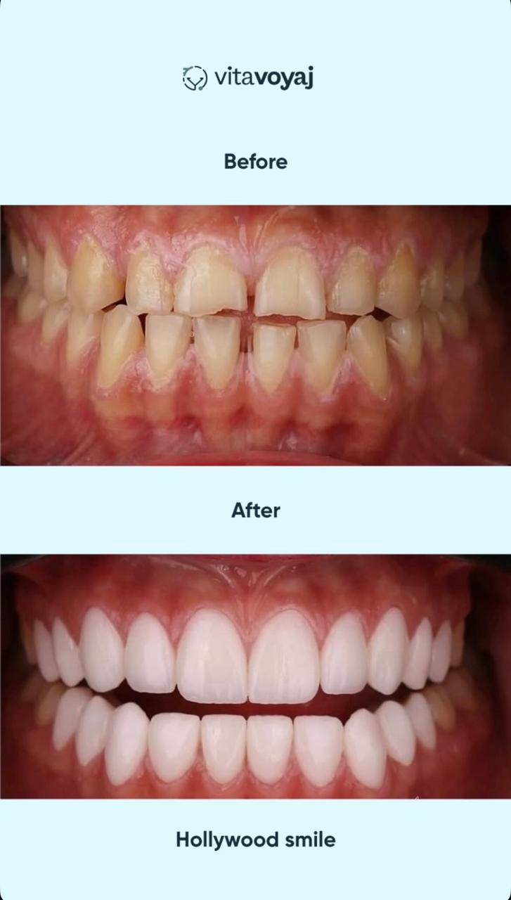 Hollywood Smile (8 Upper Teeth) - Image 18