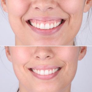 Gummy Smile Correction
