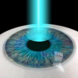 Femto LASIK