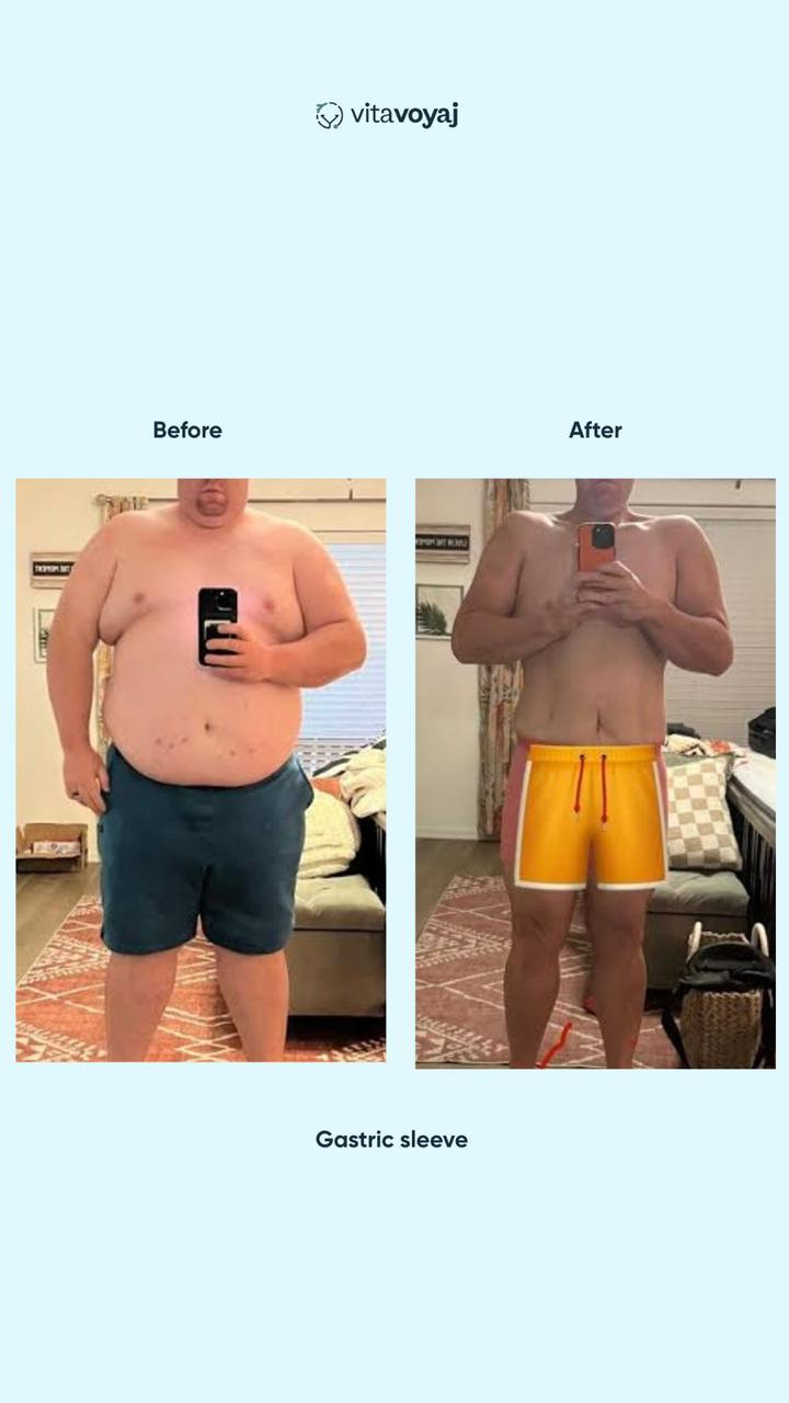 Gastric Sleeve - Image 4