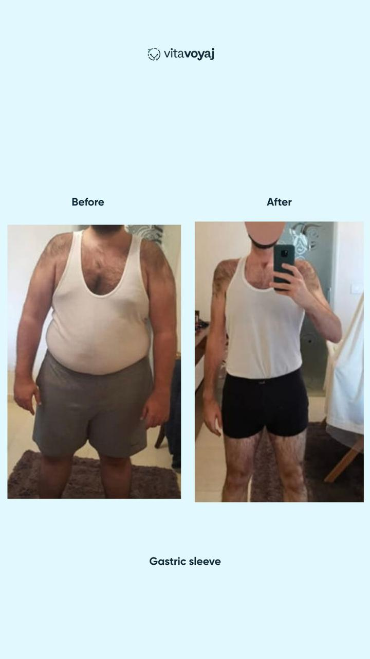 Gastric Sleeve