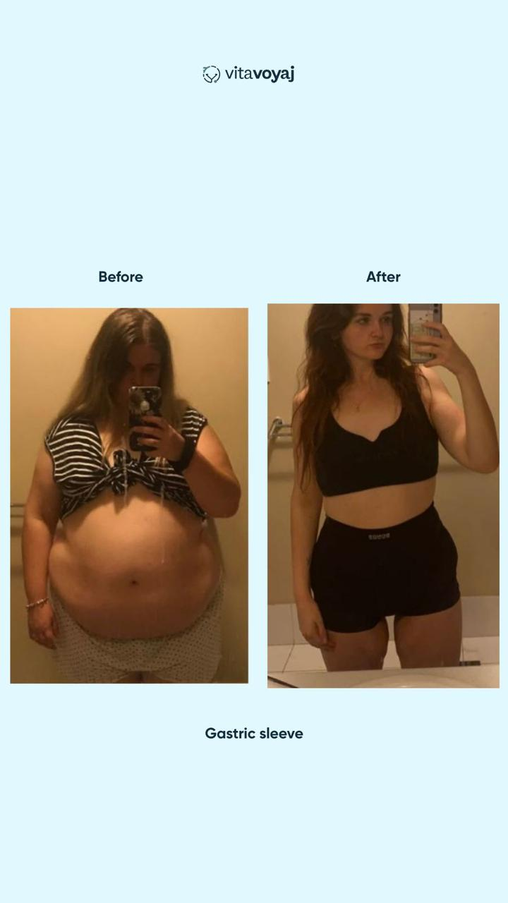 Gastric Sleeve - Image 3