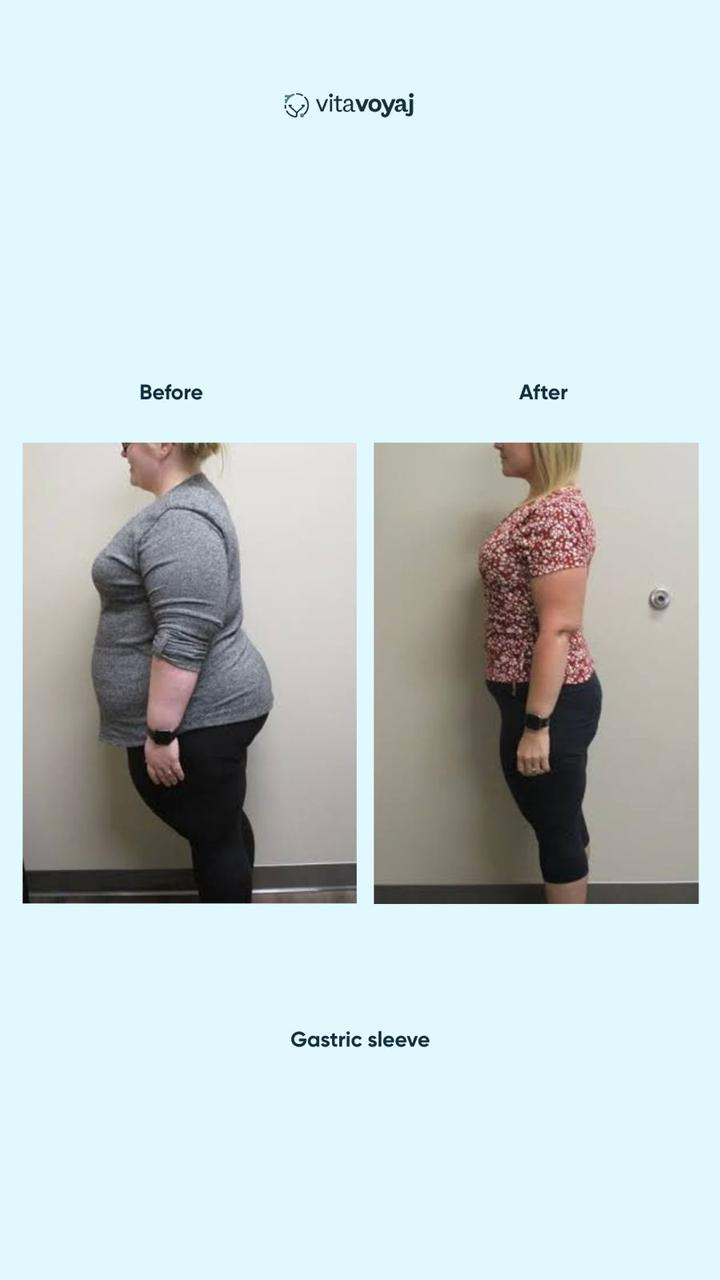 Gastric Sleeve - Image 2
