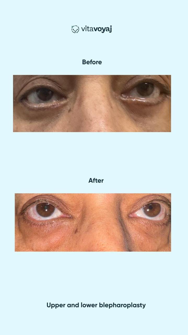 Blepharoplasty