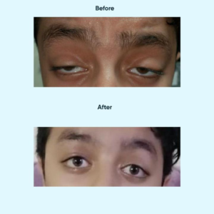 Lid Ptosis