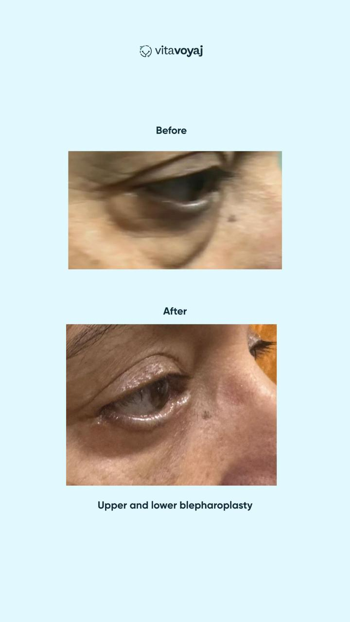 Blepharoplasty - Image 3