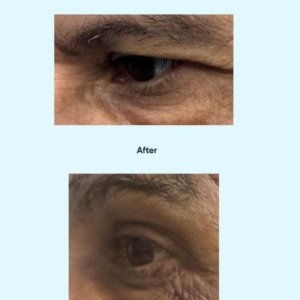 Brow Ptosis