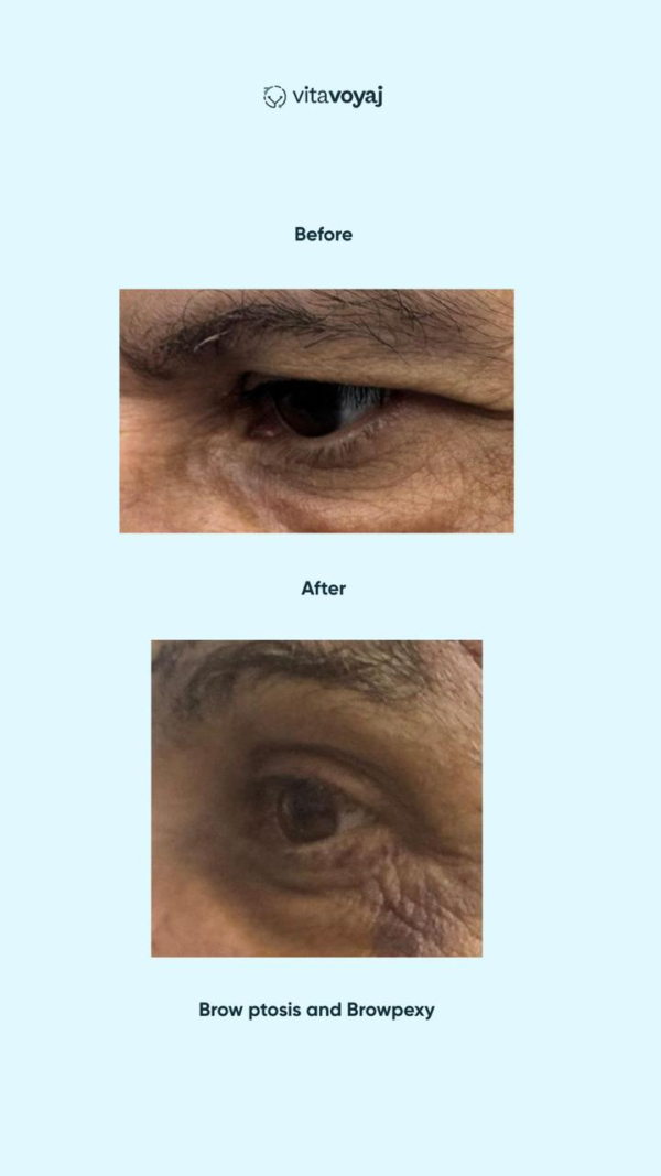 Brow Ptosis