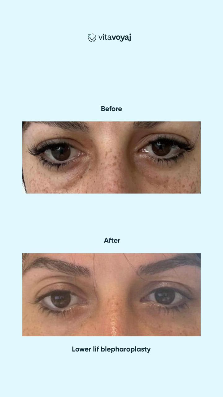 Blepharoplasty - Image 2